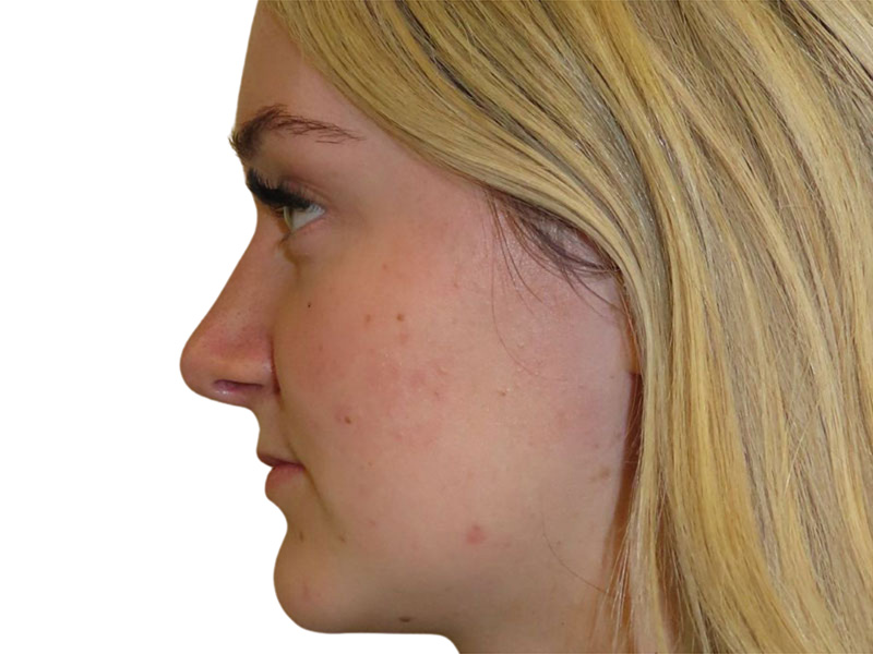 Rhinoplasty Beverly Hills