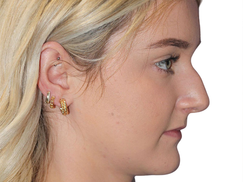 Rhinoplasty Before and After | PERK Plastic Surgery