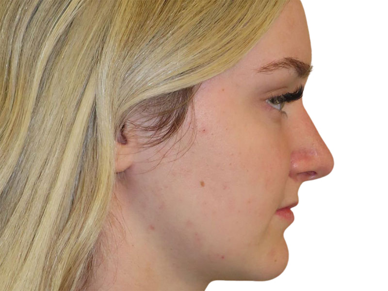 Rhinoplasty Before and After | PERK Plastic Surgery