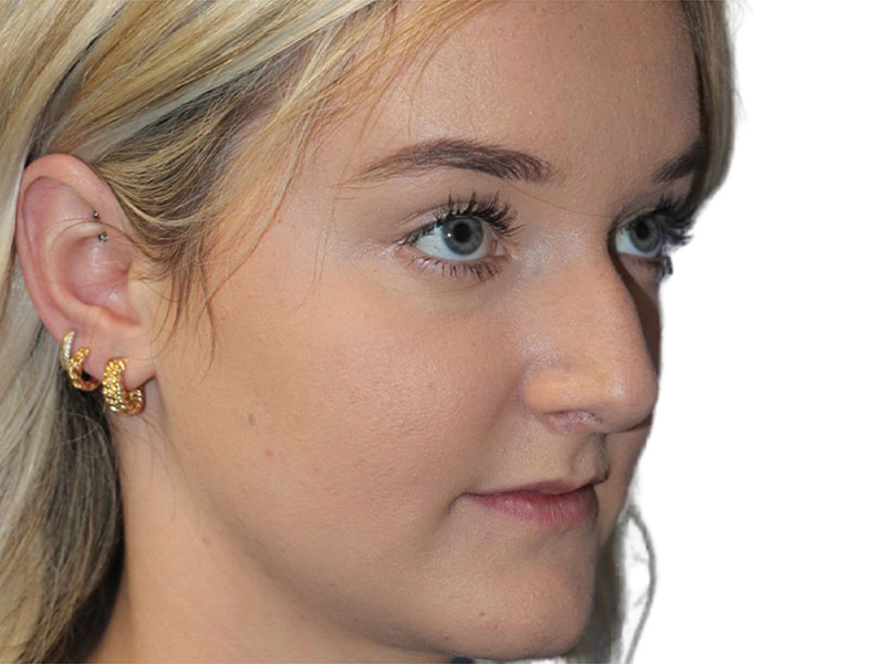 Rhinoplasty Before and After | PERK Plastic Surgery