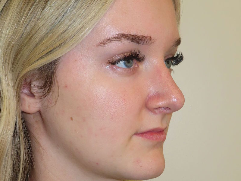 Rhinoplasty Before and After | PERK Plastic Surgery