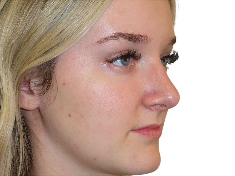 Rhinoplasty Before and After | PERK Plastic Surgery