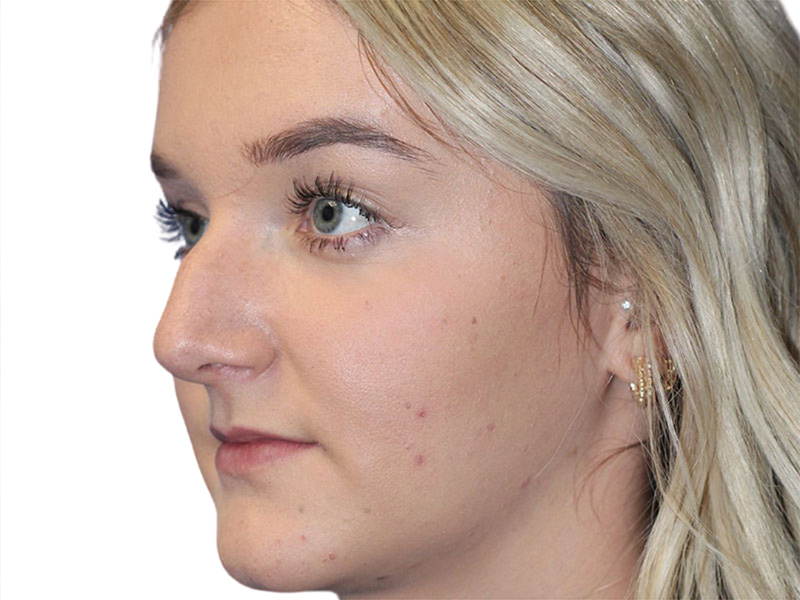 Rhinoplasty Before and After | PERK Plastic Surgery