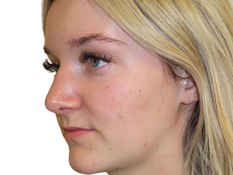 Rhinoplasty Before and After | PERK Plastic Surgery