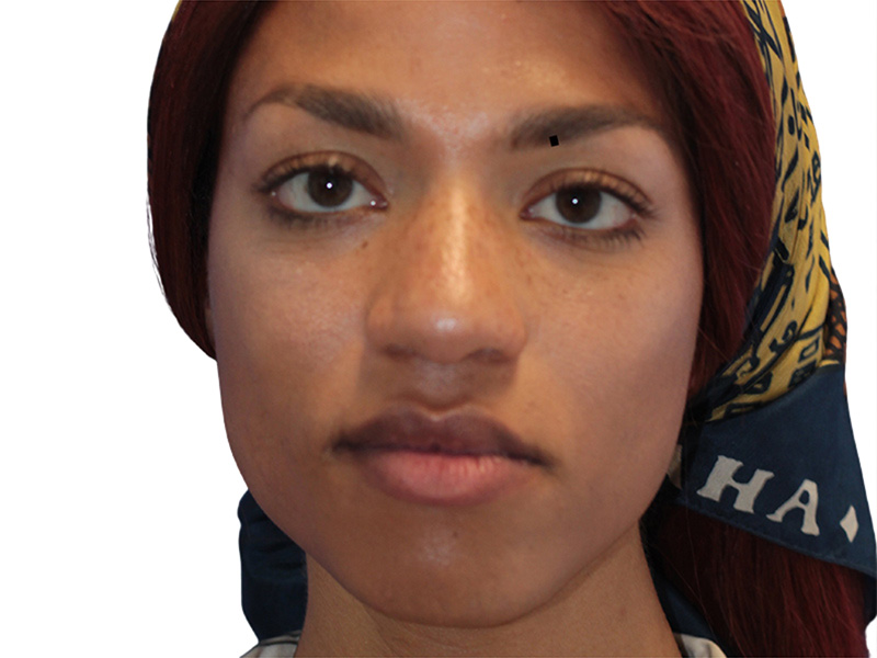 Rhinoplasty Beverly Hills