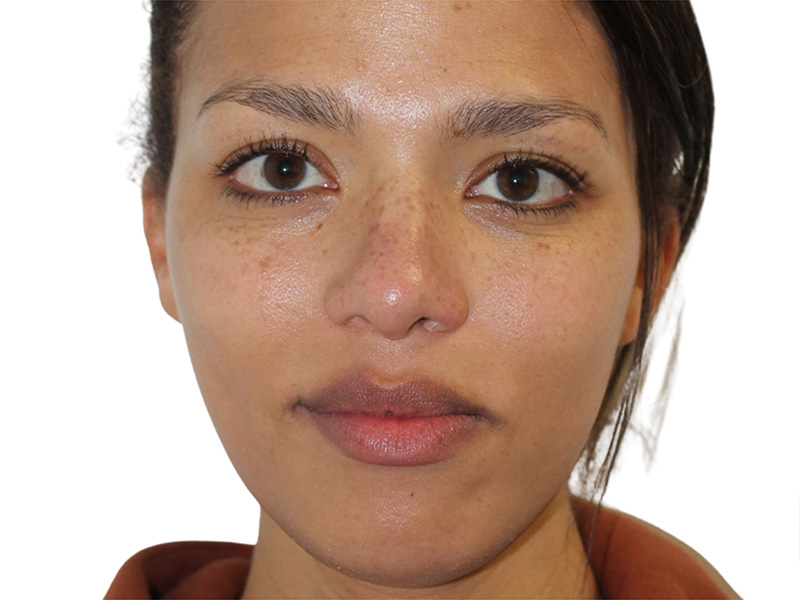 Rhinoplasty Beverly Hills