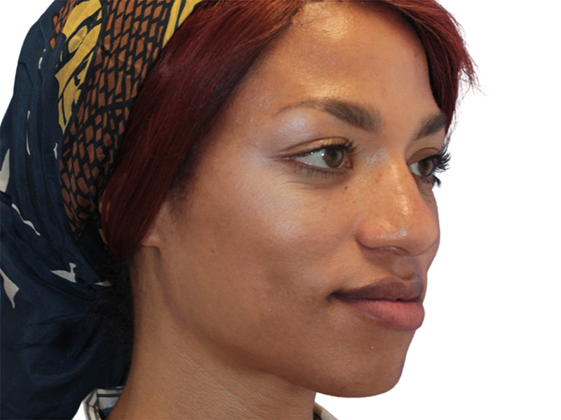 Rhinoplasty Before and After | PERK Plastic Surgery