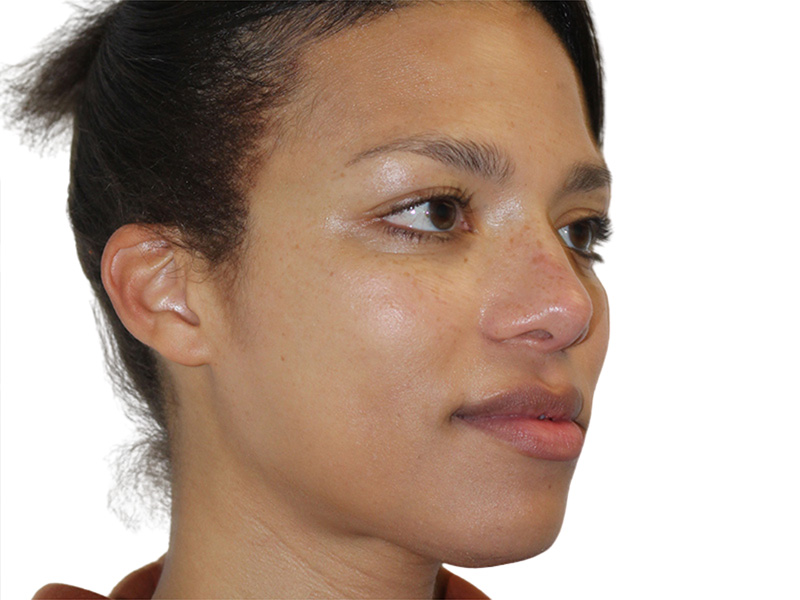 Rhinoplasty Before and After | PERK Plastic Surgery