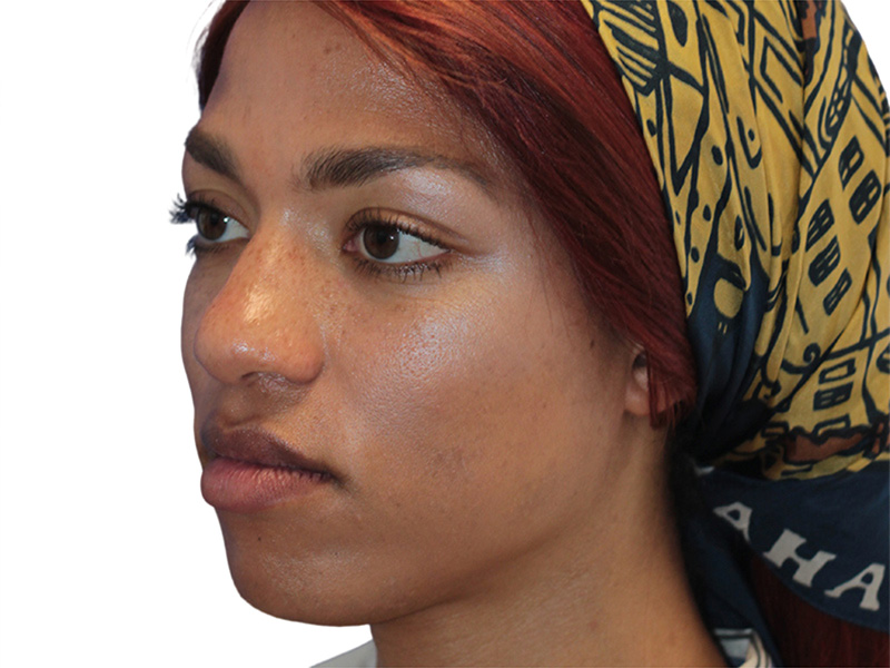 Rhinoplasty Before and After | PERK Plastic Surgery