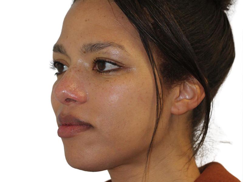 Rhinoplasty Before and After | PERK Plastic Surgery