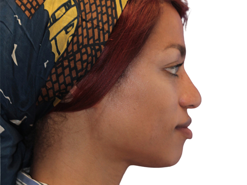 Rhinoplasty Before and After | PERK Plastic Surgery