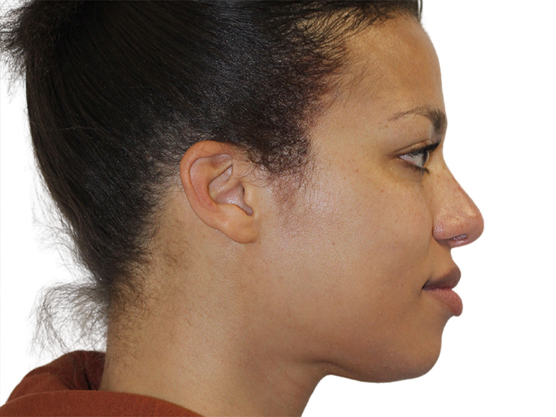 Rhinoplasty Before and After | PERK Plastic Surgery