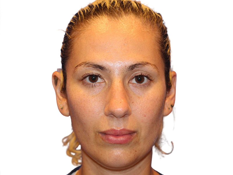 Rhinoplasty Before and After | PERK Plastic Surgery