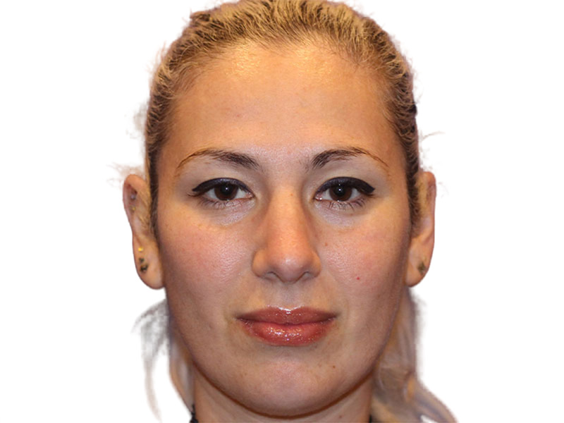 Rhinoplasty Before and After | PERK Plastic Surgery