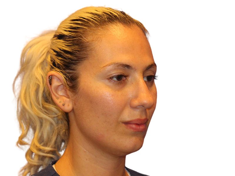 Rhinoplasty Before and After | PERK Plastic Surgery