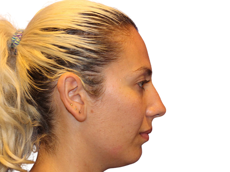 Rhinoplasty Before and After | PERK Plastic Surgery