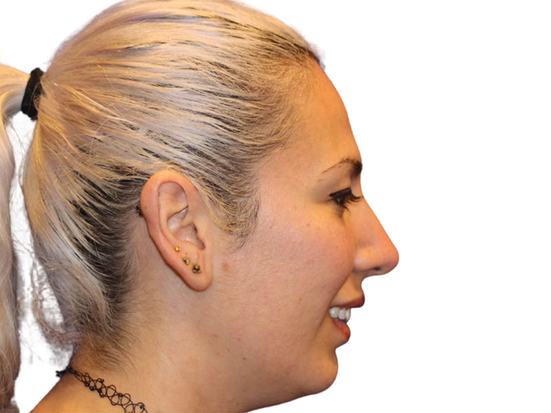 Rhinoplasty Before and After | PERK Plastic Surgery