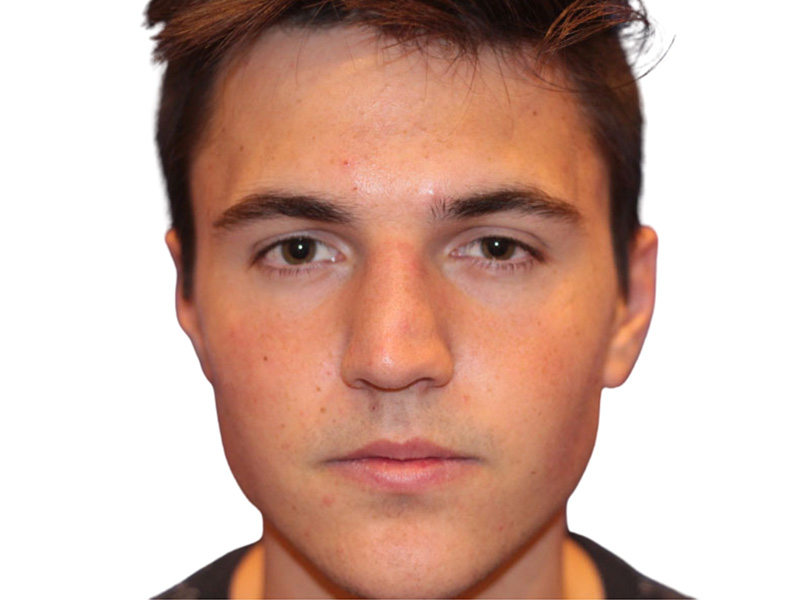 Rhinoplasty Before and After | PERK Plastic Surgery