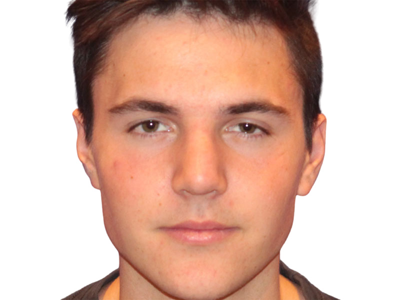 Rhinoplasty Before and After | PERK Plastic Surgery