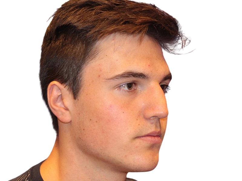Rhinoplasty Before and After | PERK Plastic Surgery