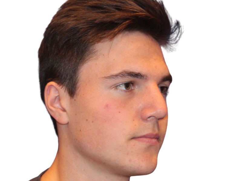 Rhinoplasty Before and After | PERK Plastic Surgery