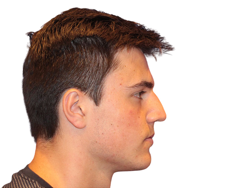 Rhinoplasty Before and After | PERK Plastic Surgery