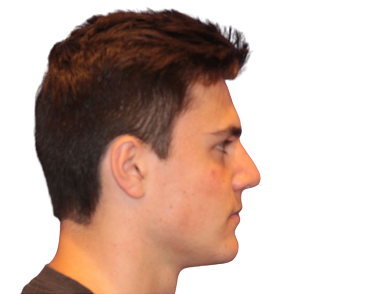 Rhinoplasty Before and After | PERK Plastic Surgery