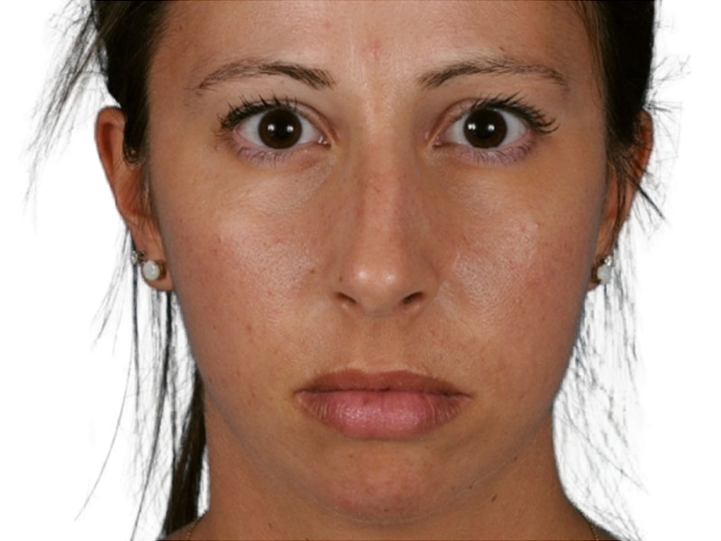 Rhinoplasty Before and After | PERK Plastic Surgery