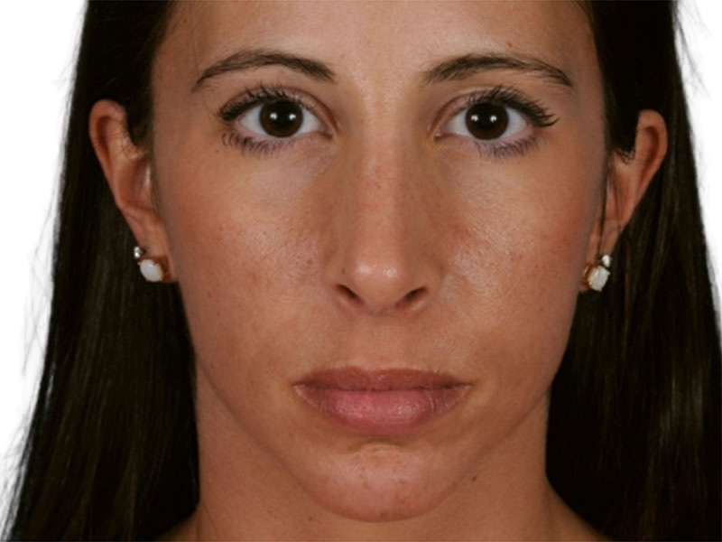 Rhinoplasty Before and After | PERK Plastic Surgery