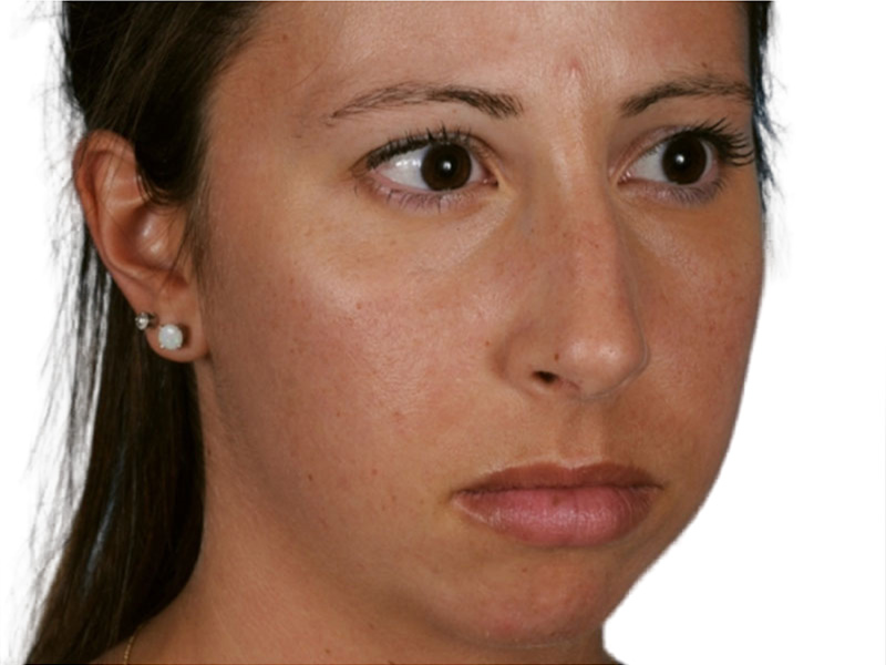 Rhinoplasty Before and After | PERK Plastic Surgery
