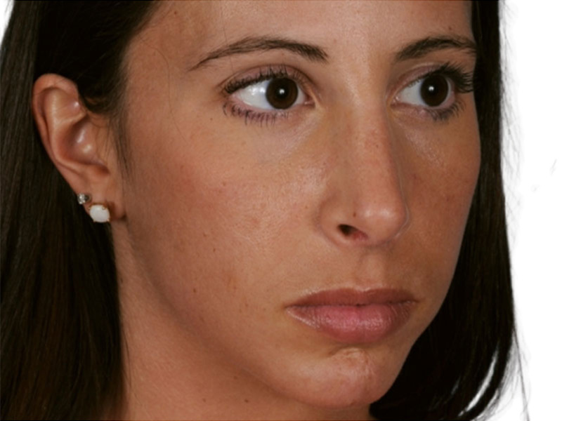 Rhinoplasty Before and After | PERK Plastic Surgery