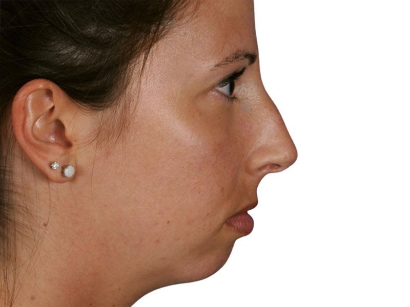 Rhinoplasty Before and After | PERK Plastic Surgery