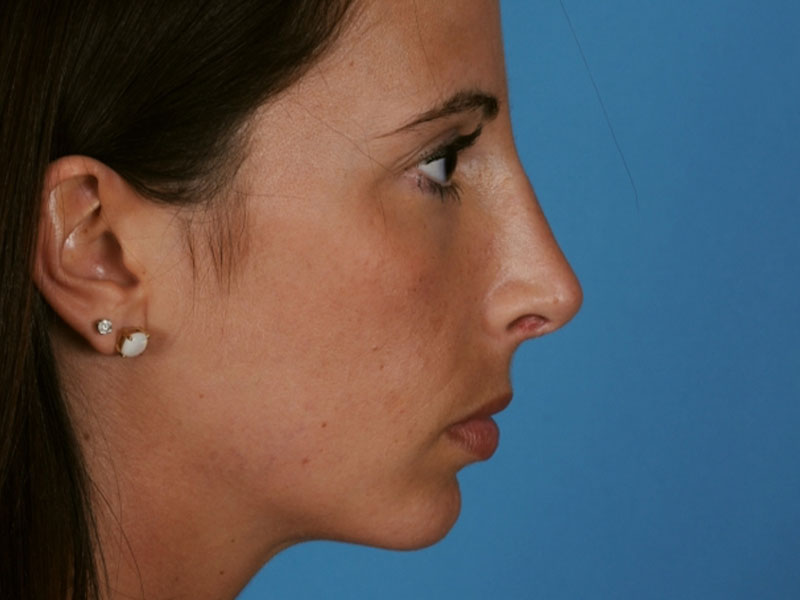 Rhinoplasty Before and After | PERK Plastic Surgery