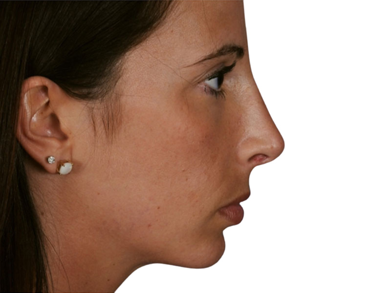 Rhinoplasty Before and After | PERK Plastic Surgery