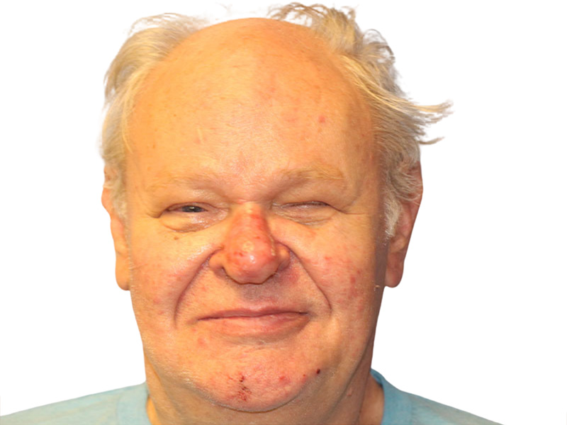 Rhinoplasty Before and After | PERK Plastic Surgery