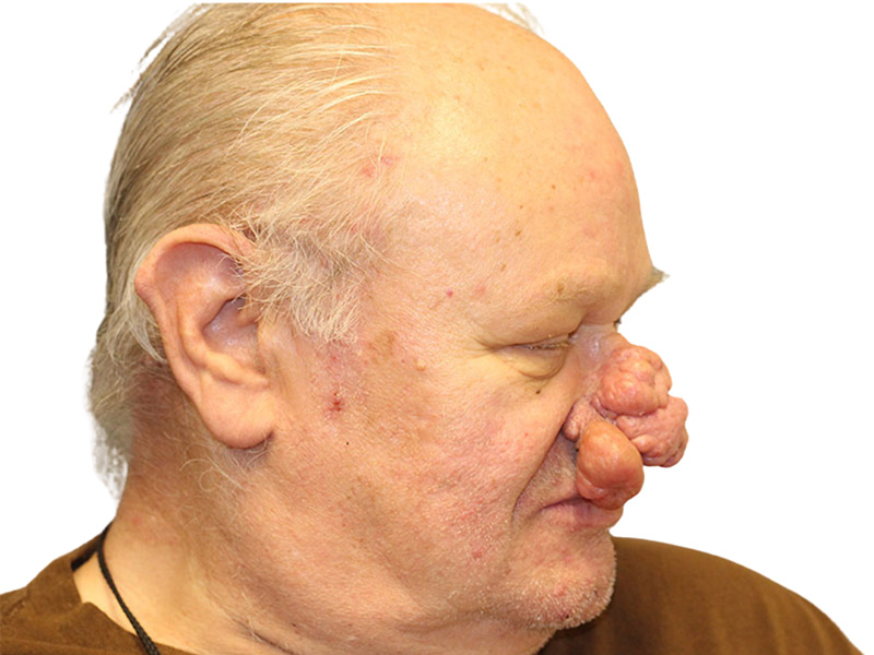 Rhinoplasty Before and After | PERK Plastic Surgery