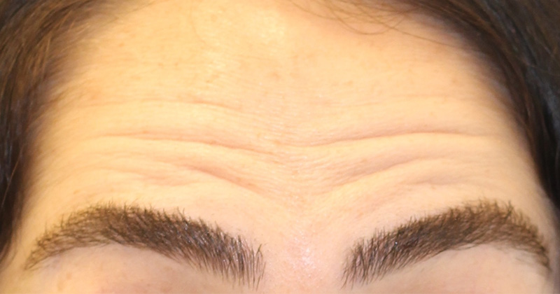 Botox Before and After | PERK Plastic Surgery
