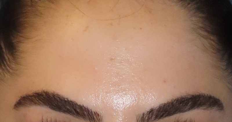 Botox Before and After | PERK Plastic Surgery