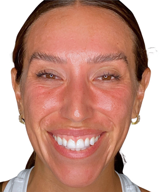 Botox Before and After | PERK Plastic Surgery
