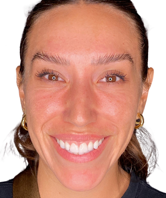 Botox Before and After | PERK Plastic Surgery