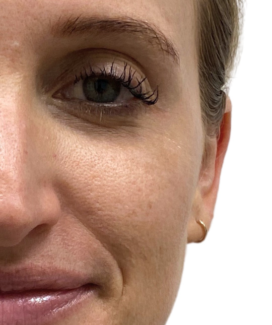 Botox Before and After | PERK Plastic Surgery