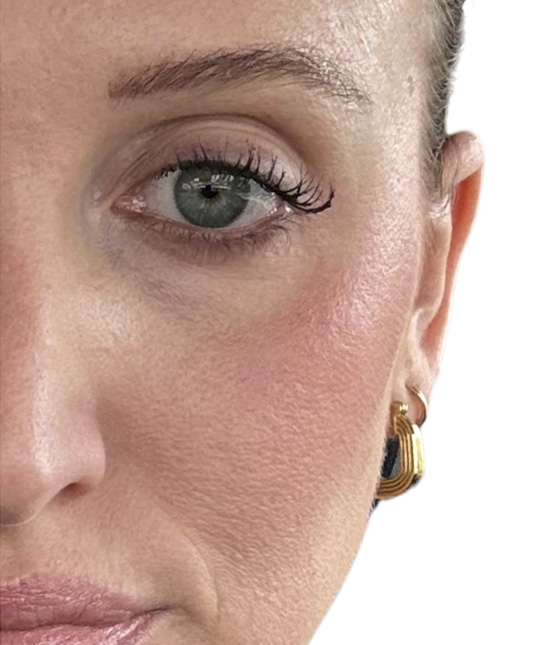 Botox Before and After | PERK Plastic Surgery