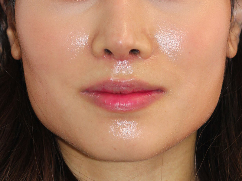 Botox Before and After | PERK Plastic Surgery
