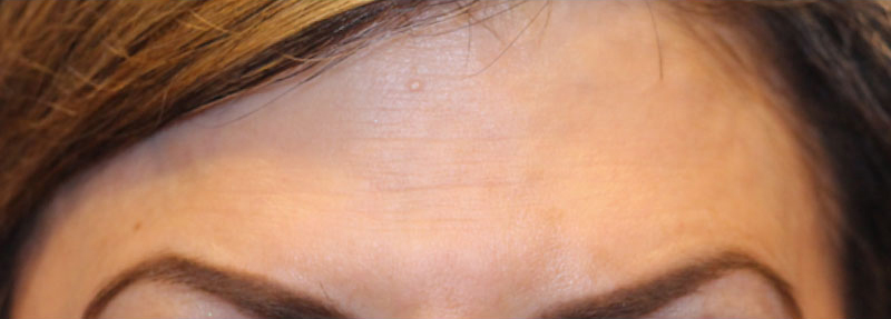 Botox Before and After | PERK Plastic Surgery