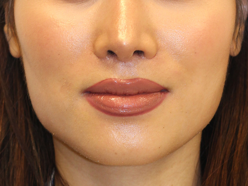 Botox Before and After | PERK Plastic Surgery