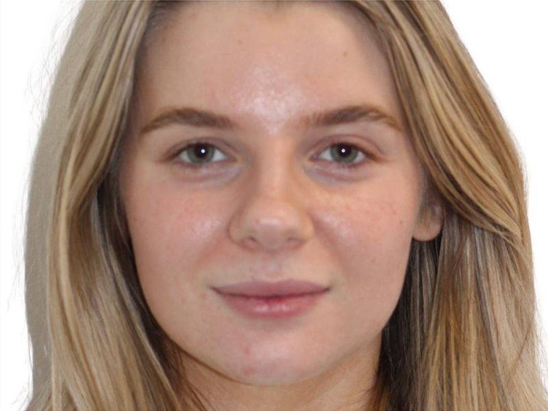Botox Before and After | PERK Plastic Surgery