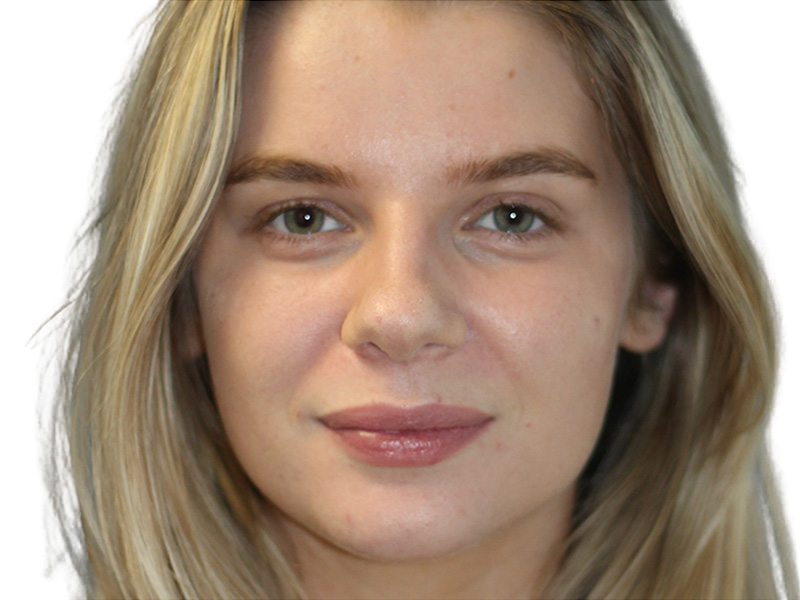 Botox Before and After | PERK Plastic Surgery