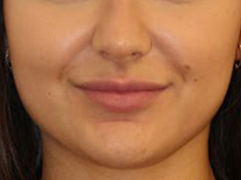 Botox Before and After | PERK Plastic Surgery
