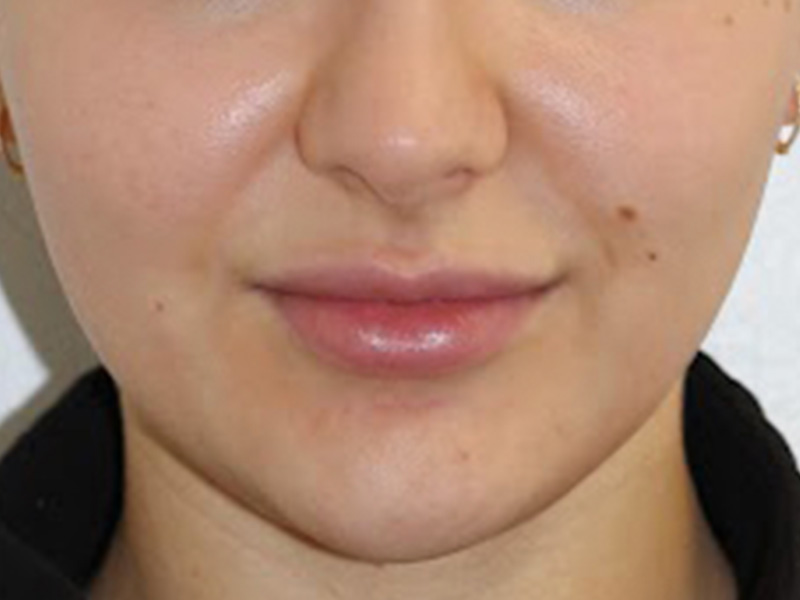 Botox Before and After | PERK Plastic Surgery