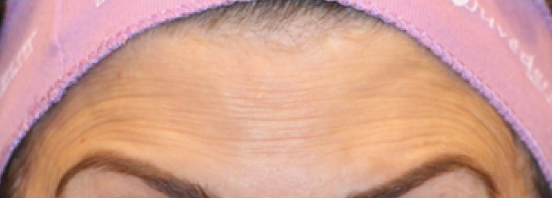 Botox Before and After | PERK Plastic Surgery